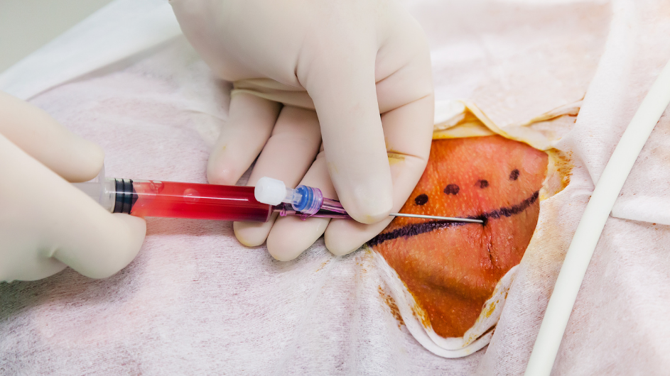 Temporary hemodialysis catheter insertion